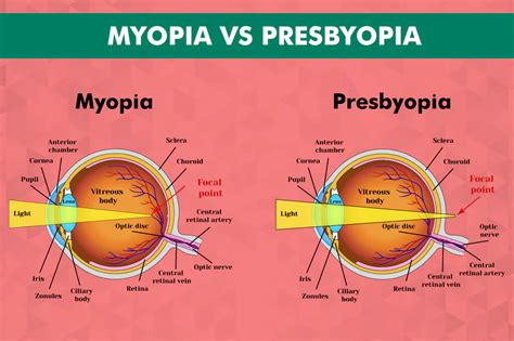 presbyopia vs myopia.